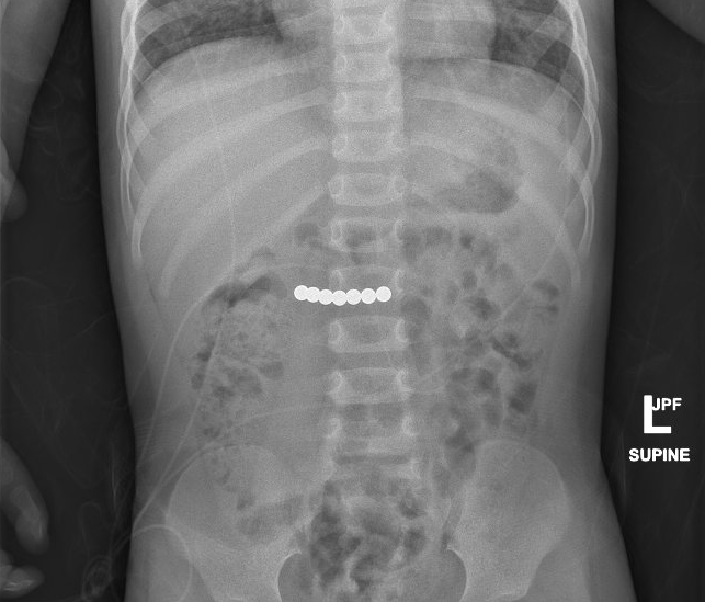 X-ray image showing rare earth magnets that have been swallowed