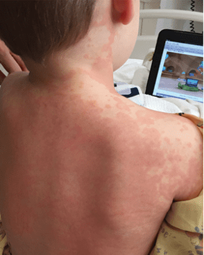 Kawasaki Disease